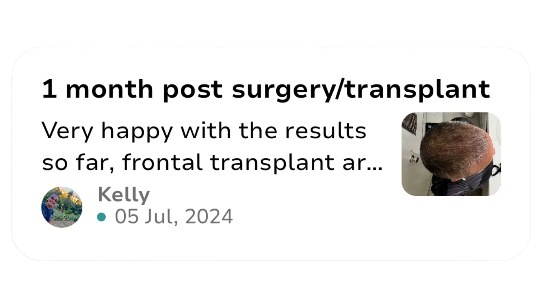 1 month post transplant Hair Back App community