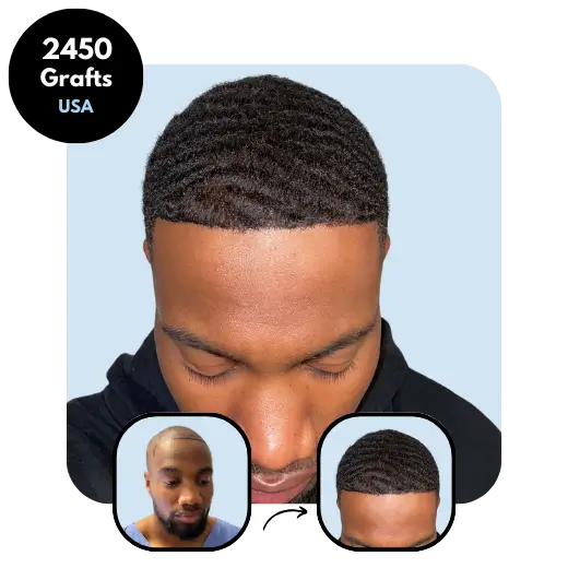 Afro FUE Hair transplant results 2450 grafts