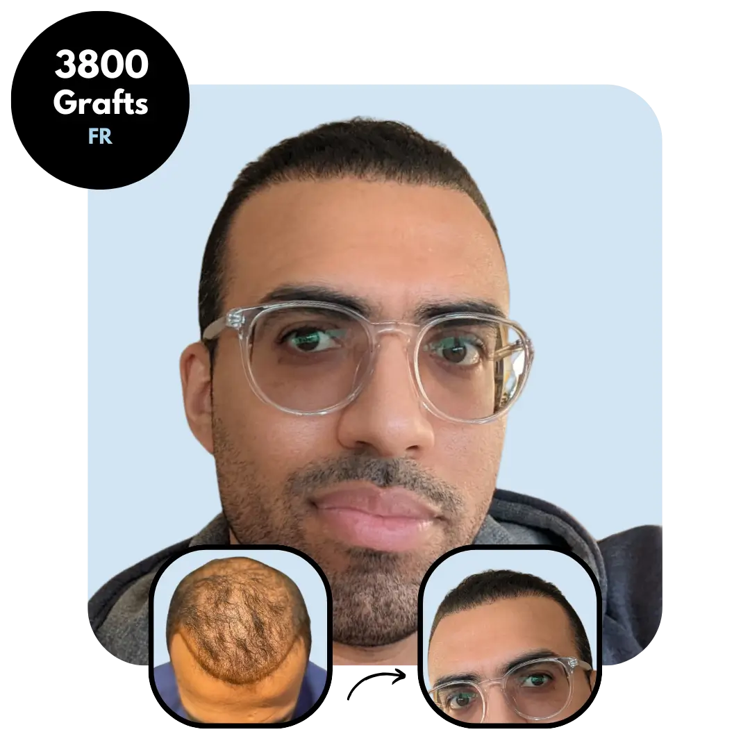 DHI Hair transplant results 3800x grafts