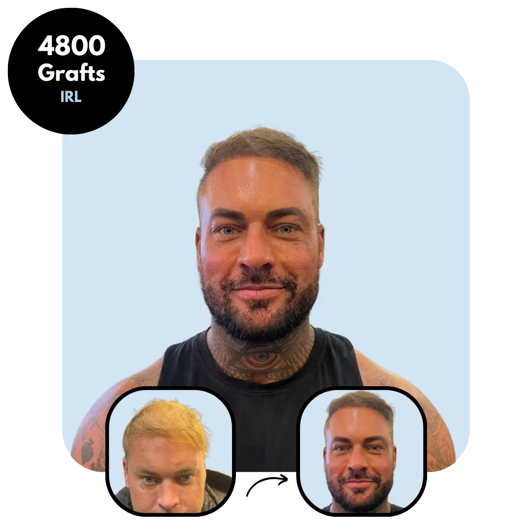 DHI Hair transplant results 4800 grafts