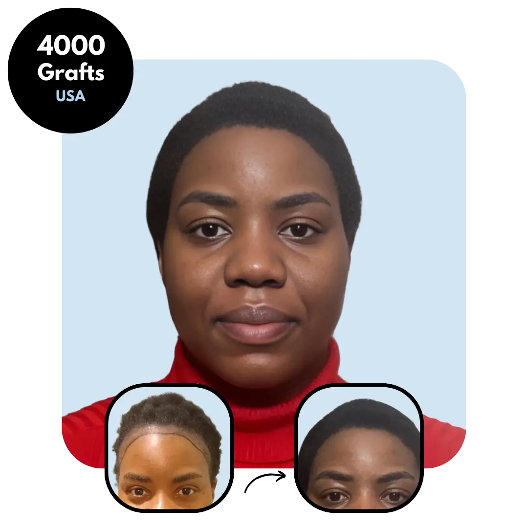 Female Afro DHI Hair transplant results 4000 grafts