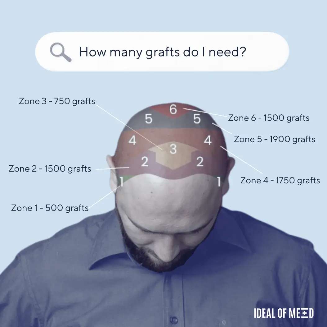 Idealofmed number of grafts