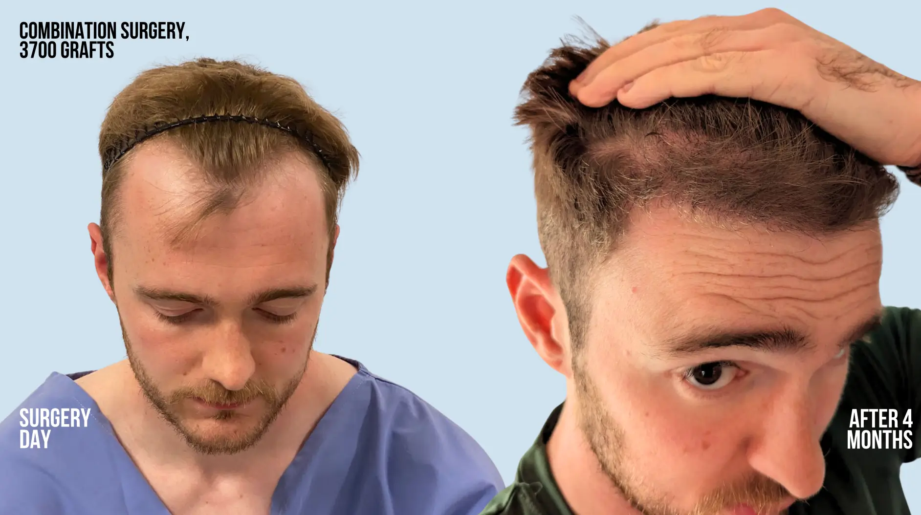 Jacob from the UK got a combination transplant using 3700 grafts. On the right he is pictured 4 months post hair transplant.