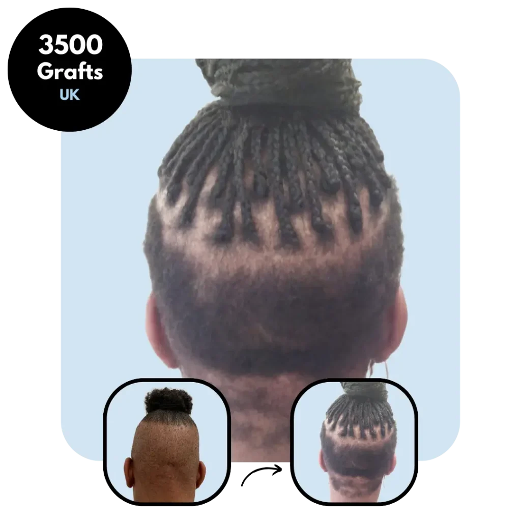 UK, 3500 Grafts FUE Female, 4 Months Progress