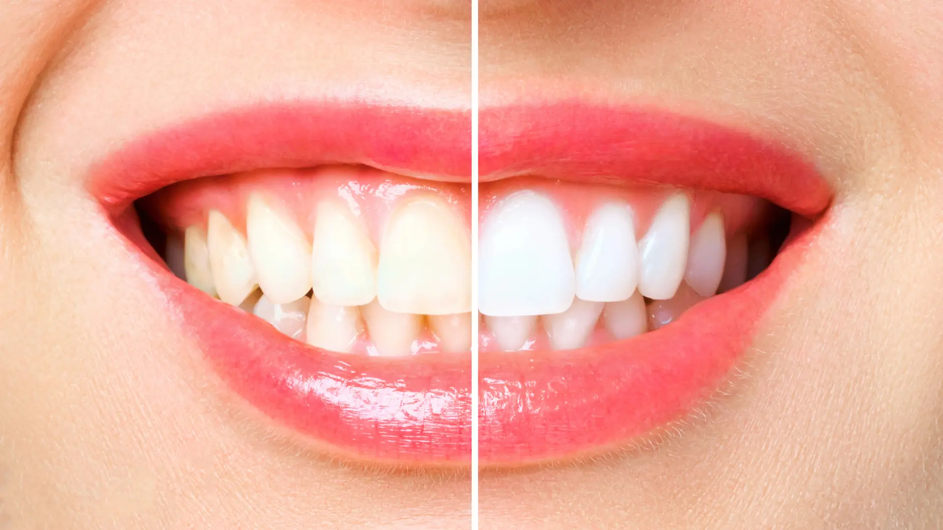 teeth whitening hack