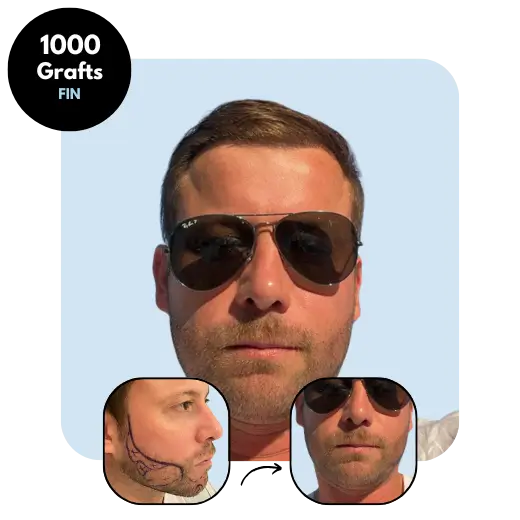 1000 Graft FUE Beard Transplant