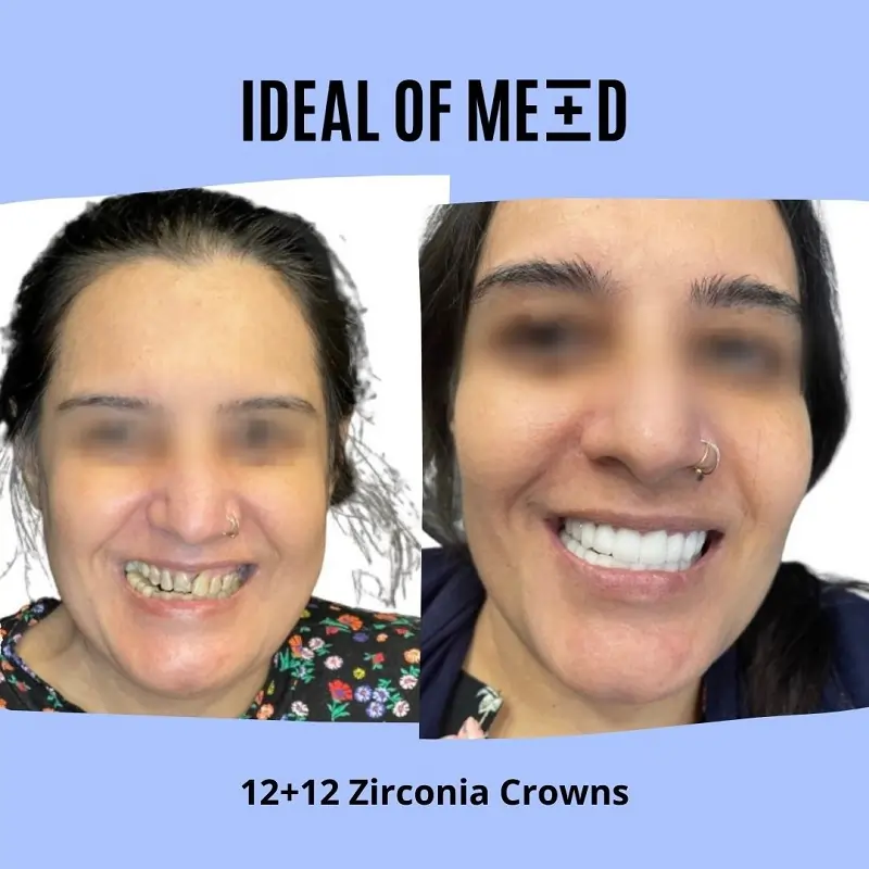 12+12 zirconia crowns idealofmed