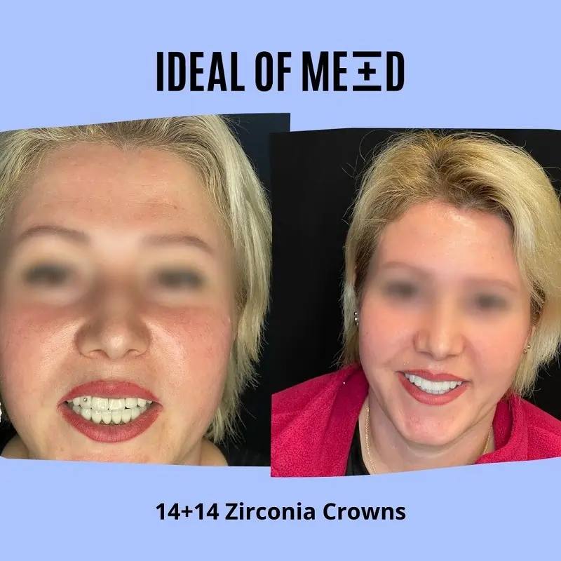 14+14 zirconia crowns idealofmed
