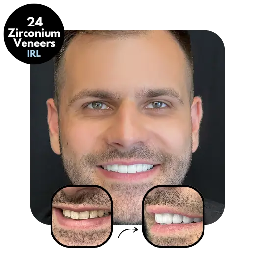 24 Zirconium Veneers Ideal of MeD