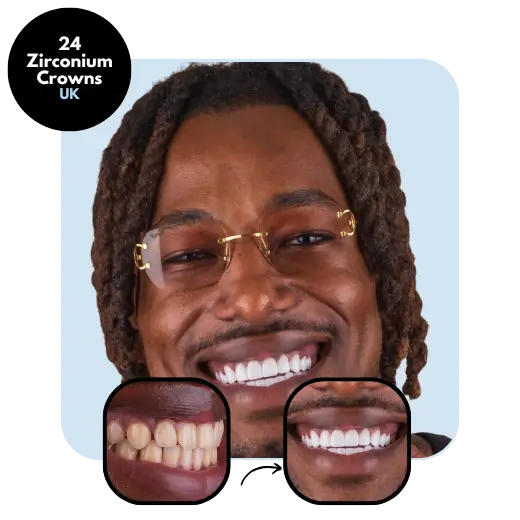 24 zirconium crowns UK