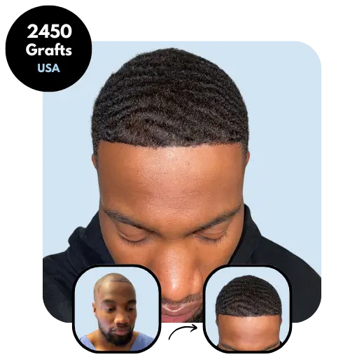 2450 grafts USA