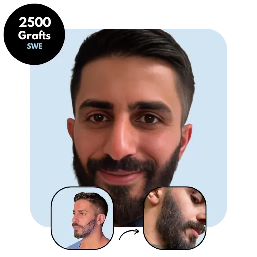 2500 Graft FUE Beard transplant