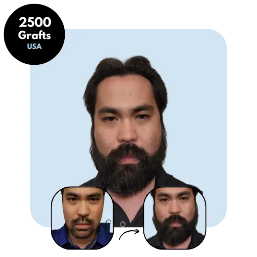2500 grafts FUE beard transplant