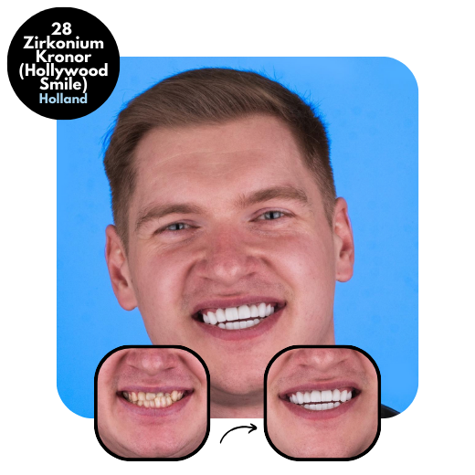 28 Zirkoniumkronor - Hollywood Smile före efter