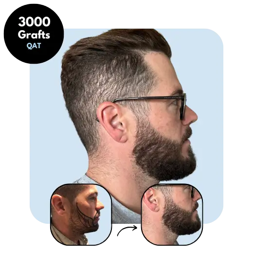 3000 Grafts FUE Beard transplant
