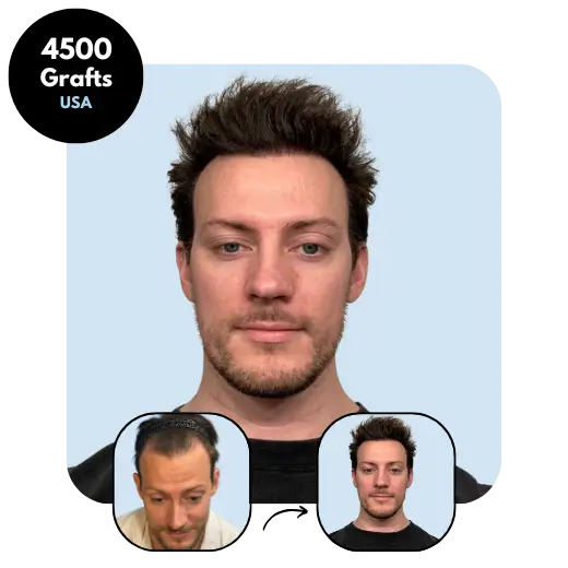 4500 grafts USA