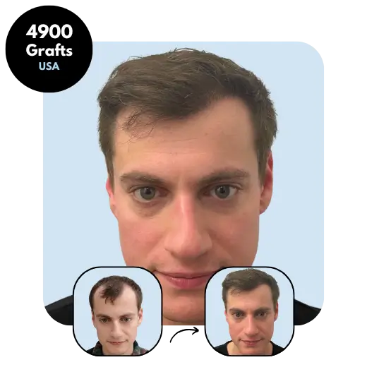 4900 grafts USA