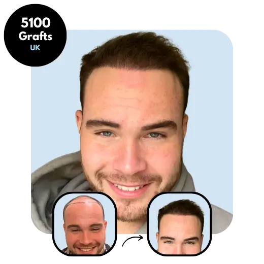 5100 grafts UK