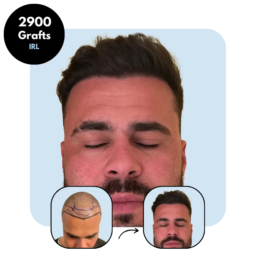 L.G. (43) from Ireland hair transplant before and after (Mix 2900 grafts)