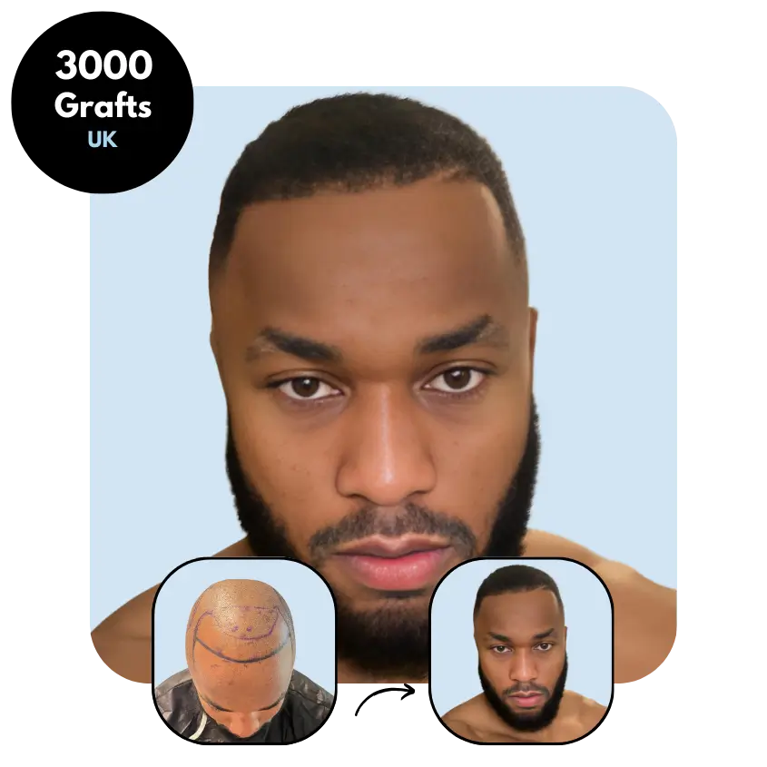 G.C. (26) from UK hair transplant before and after (DHI 3000 grafts)