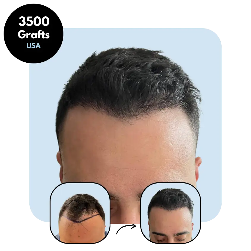 A.M. (27) from USA hair transplant before and after (Mix 3500 grafts)