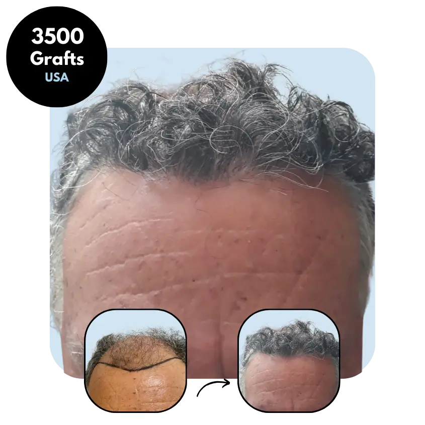 A.D. (62) from USA hair transplant before and after (FUE 3500)