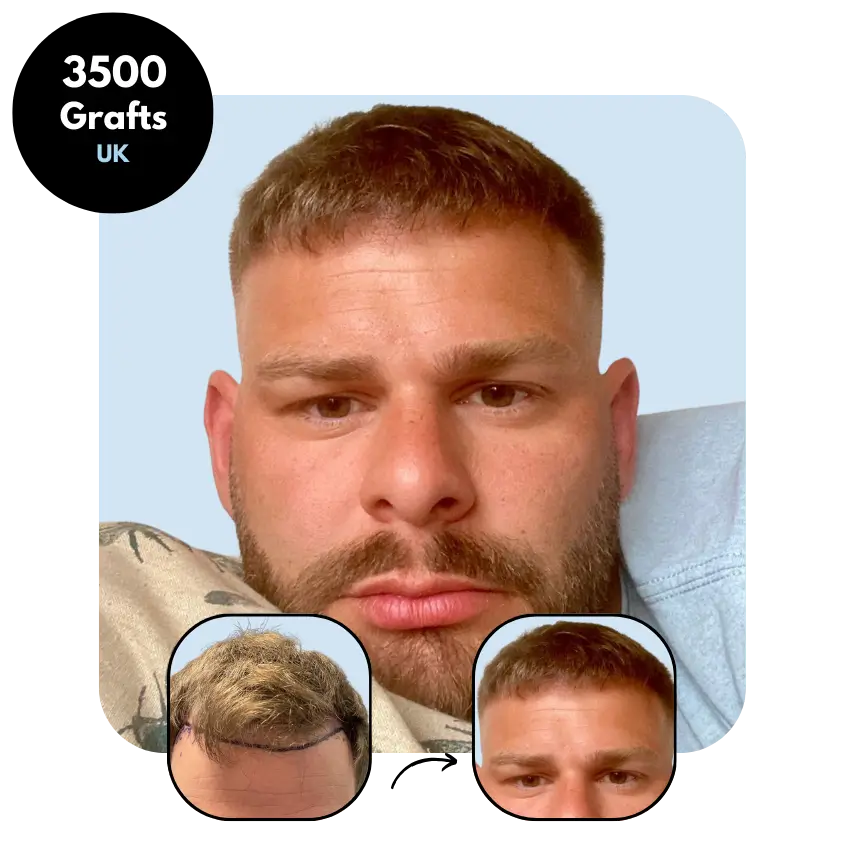 A.R. (33) from United Kingdom hair transplant before and after (DHI 3500 grafts)