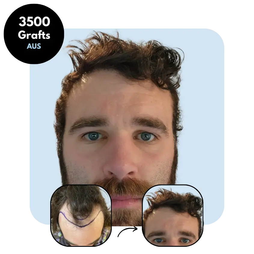 B.W. (31) from Australia hair transplant before and after (Mix 3500 grafts)