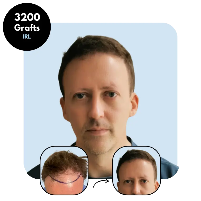 D.R. (41) from Ireland hair transplant before and after (FUE 3200 grafts)