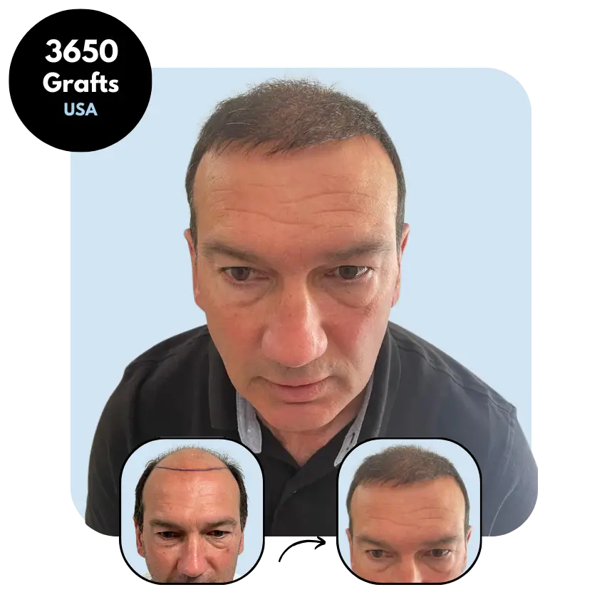 E.C. (56) from USA hair transplant before and after (FUE 3650 grafts)