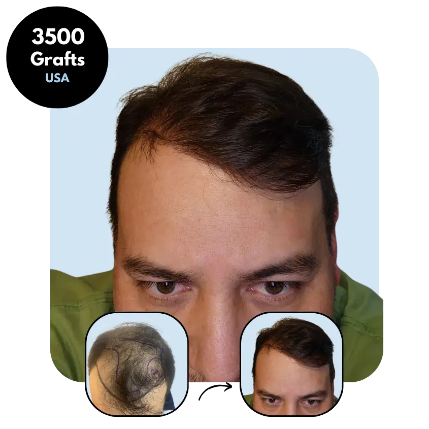 E.D. (46) from USA hair transplant before and after (Mix 3500 grafts)