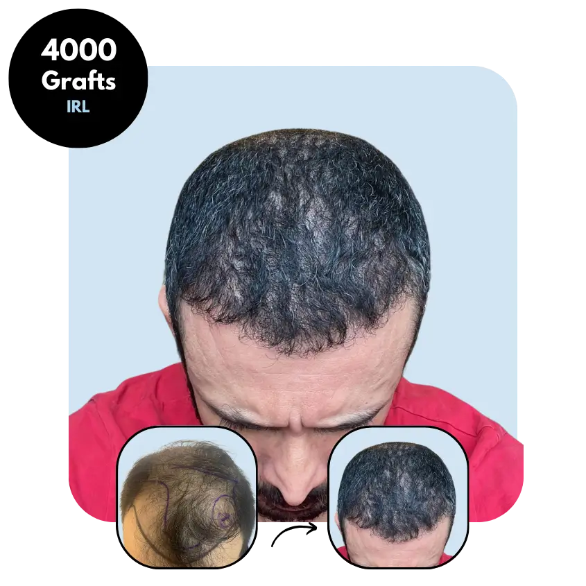 E.B.S. (42) from Ireland hair transplant before and after (Mix 4000 grafts)