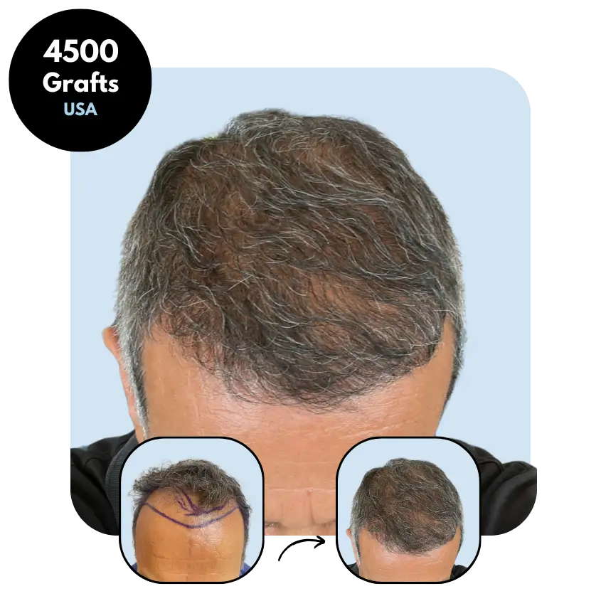 V.S. (55) from USA hair transplant before and after (Mix 4500 grafts)