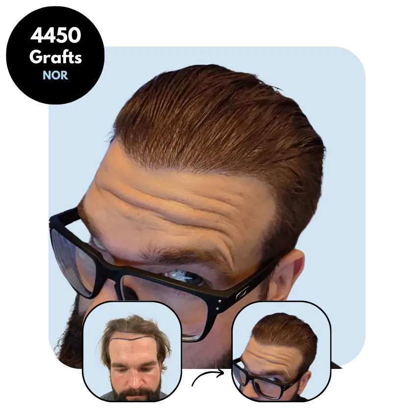 N.S. (36) from Norway hair transplant before and after (Mix 4450 grafts)
