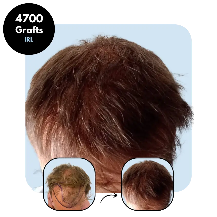 E.S. (43) from Ireland hair transplant before and after (Mix 4700 grafts)