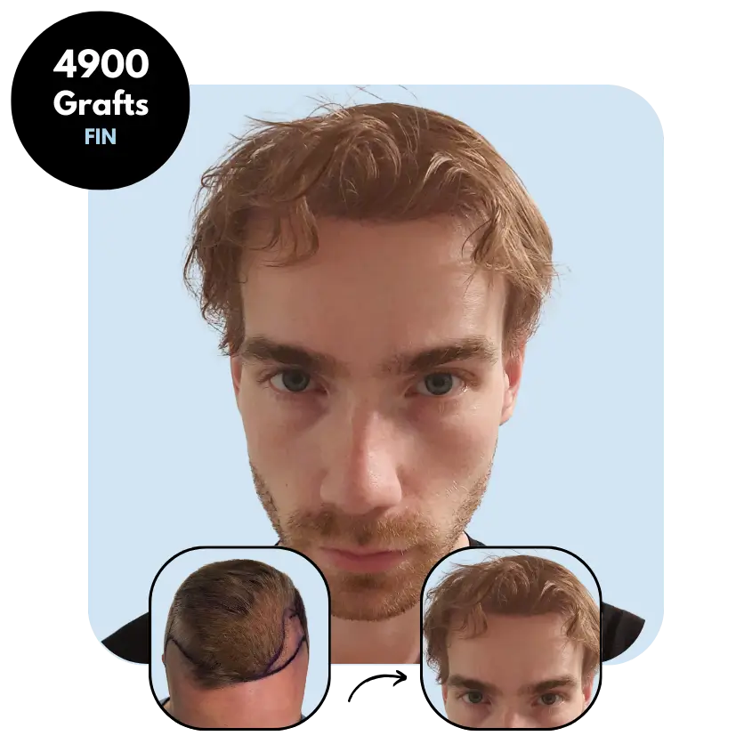 K.S. (28) from Finland hair transplant before and after (Mix 4900 grafts)
