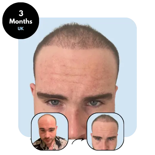 A. W. (23) from UK 3 months after hair transplant