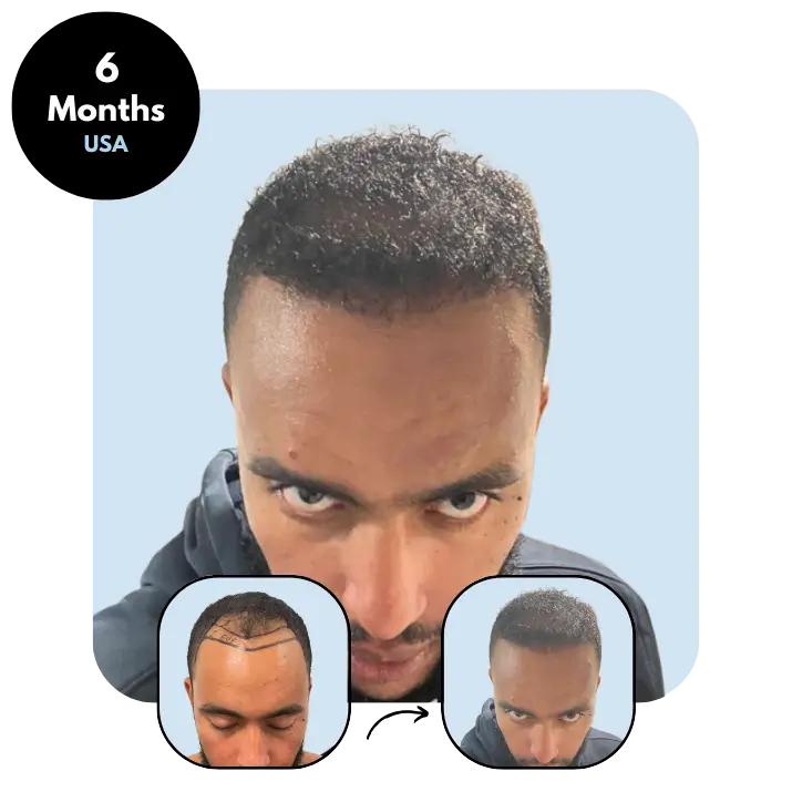 A. A - USA 25yo MIX 4100 - 6 months after hair transplant