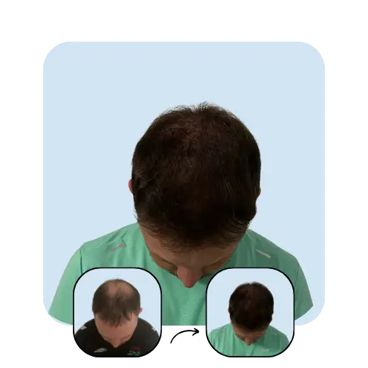 A. N 1 year after hair transplant