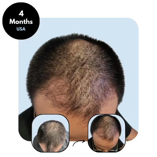 A.G. (36) from USA after hair transplant month 4