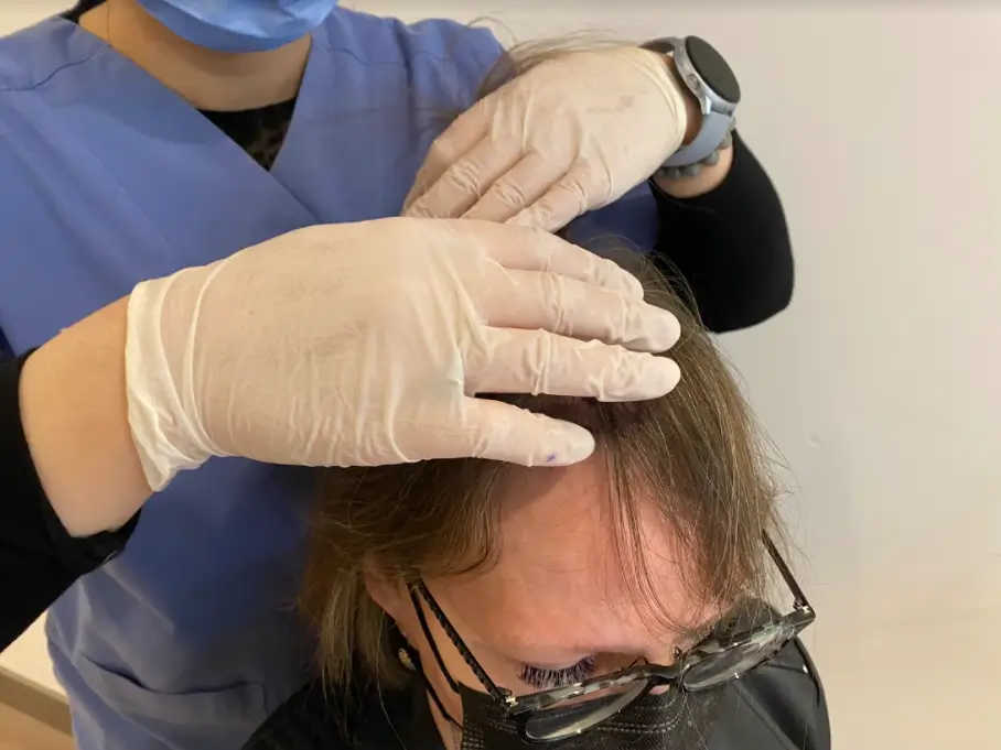 Assess the donor area before hair transplant