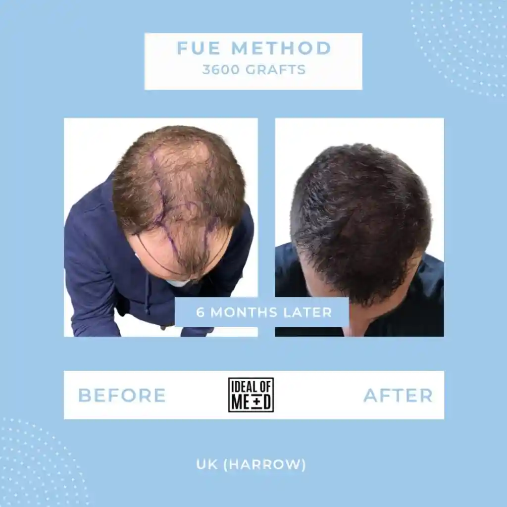Before and After - FUE method 3600 grafts