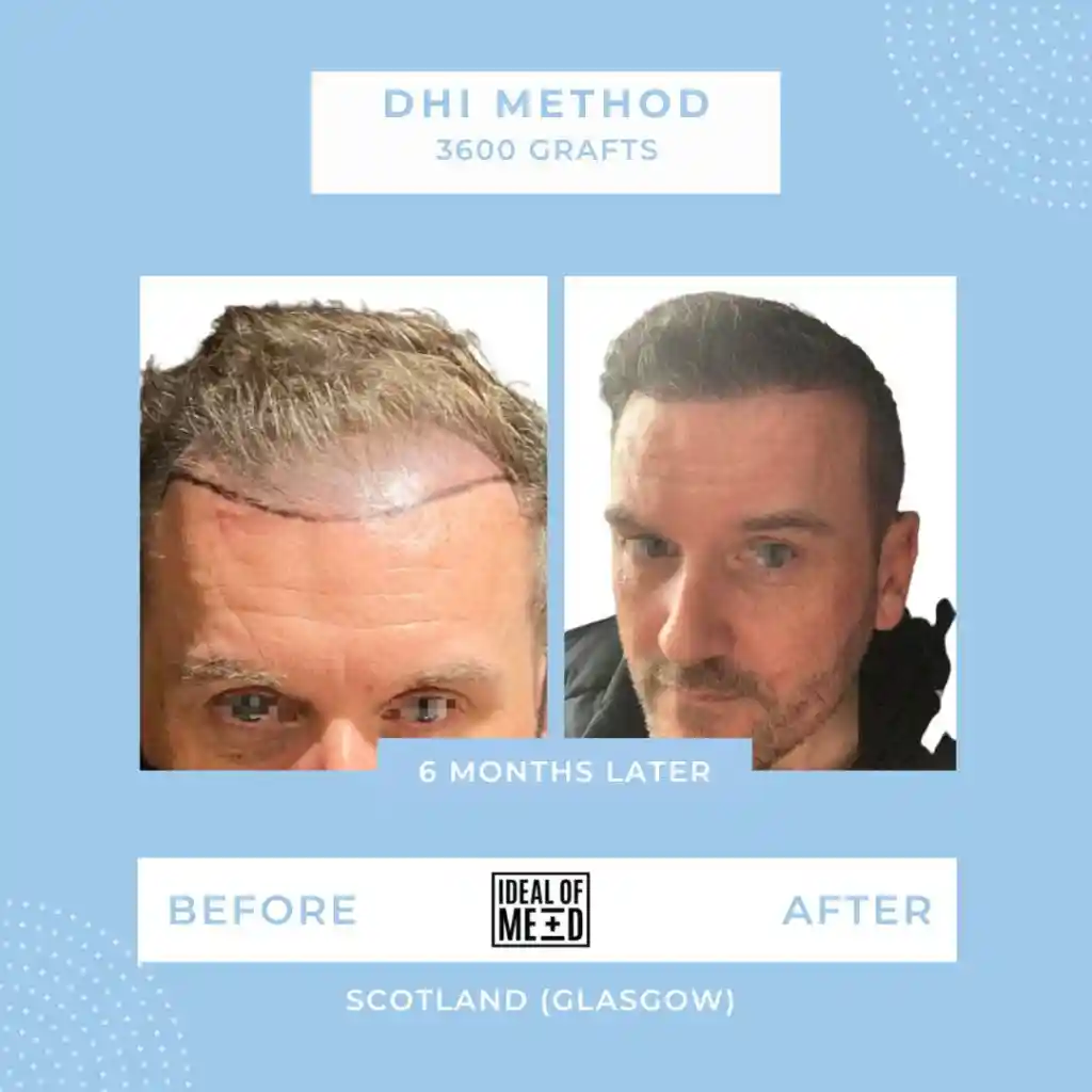 Before and After - DHI method 3600 grafts