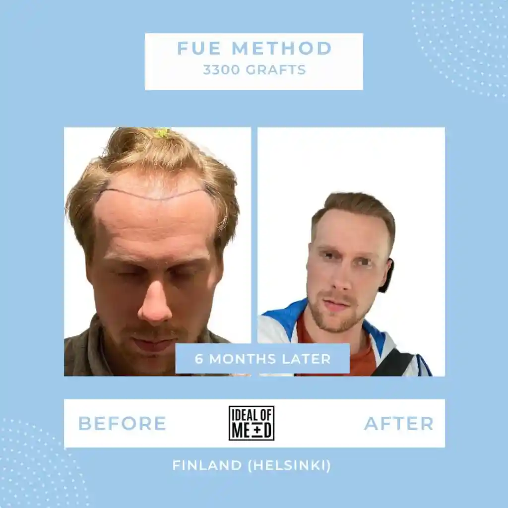Before and After - FUE method 3300 grafts