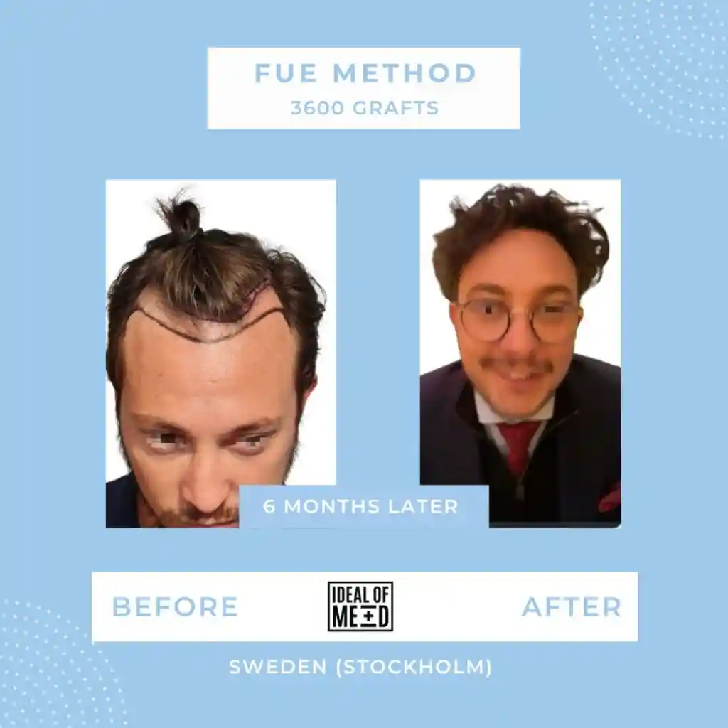Before and After - FUE method 3600 grafts