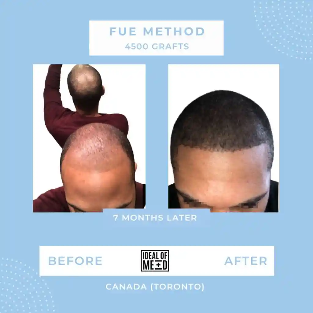 Before and After - FUE method 4500 grafts