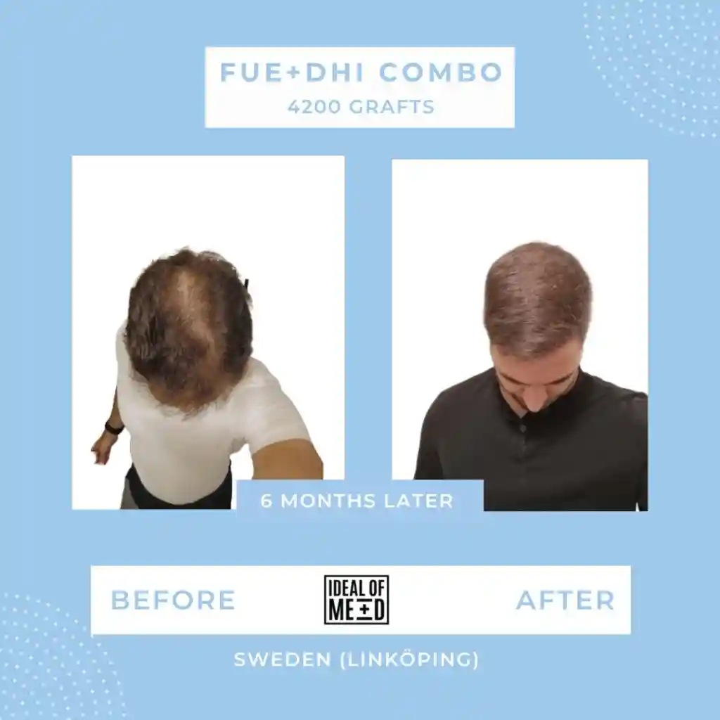 Before and After - FUE + DHI Combo