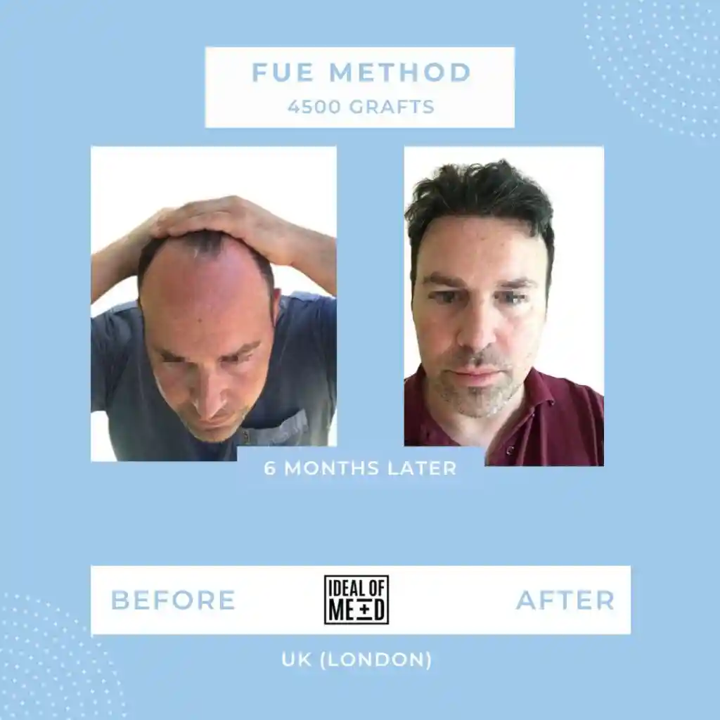 Before and After - FUE method 4500 grafts