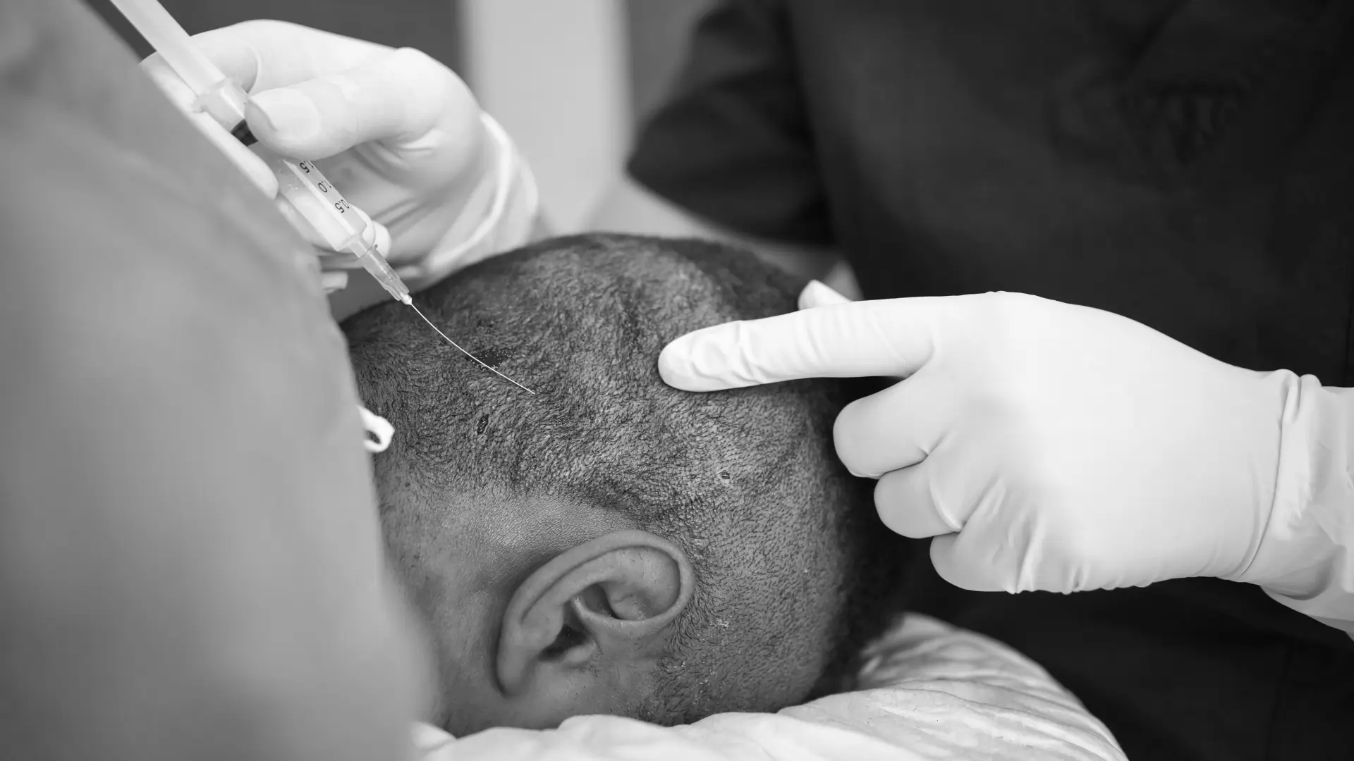 Botched Hair Transplant / Turkey hair transplants gone wrong