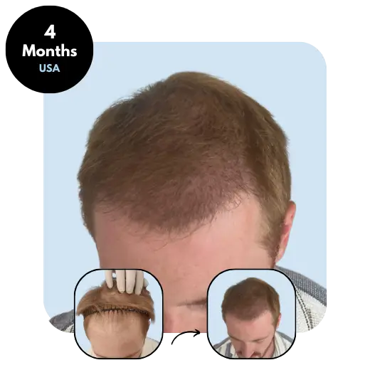 C.H. (30) from USA after hair transplant month 4